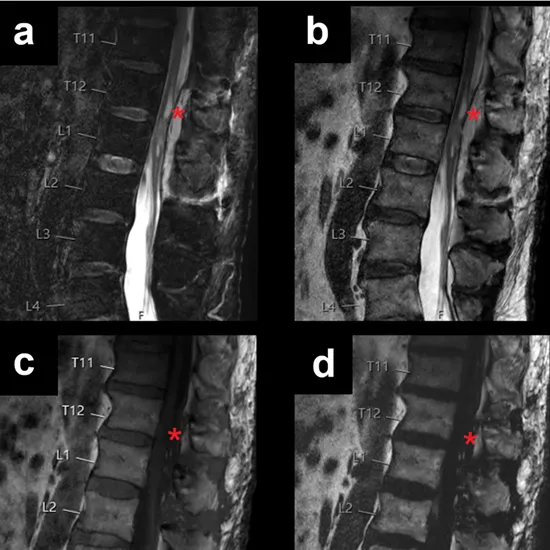 mri thoracic double contrast only